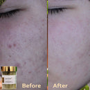 acne solution kit for face products